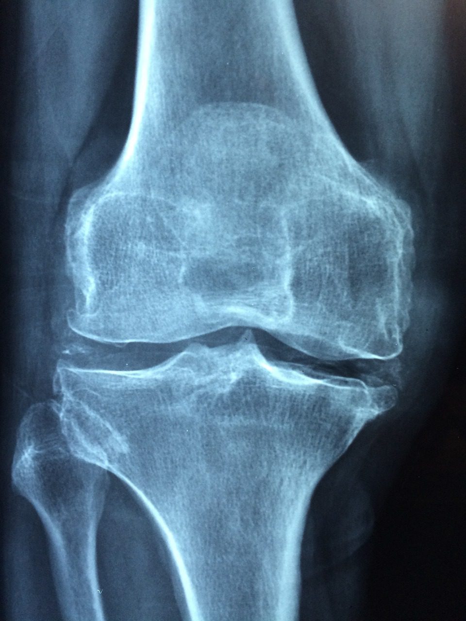 Knee Injury X-Ray