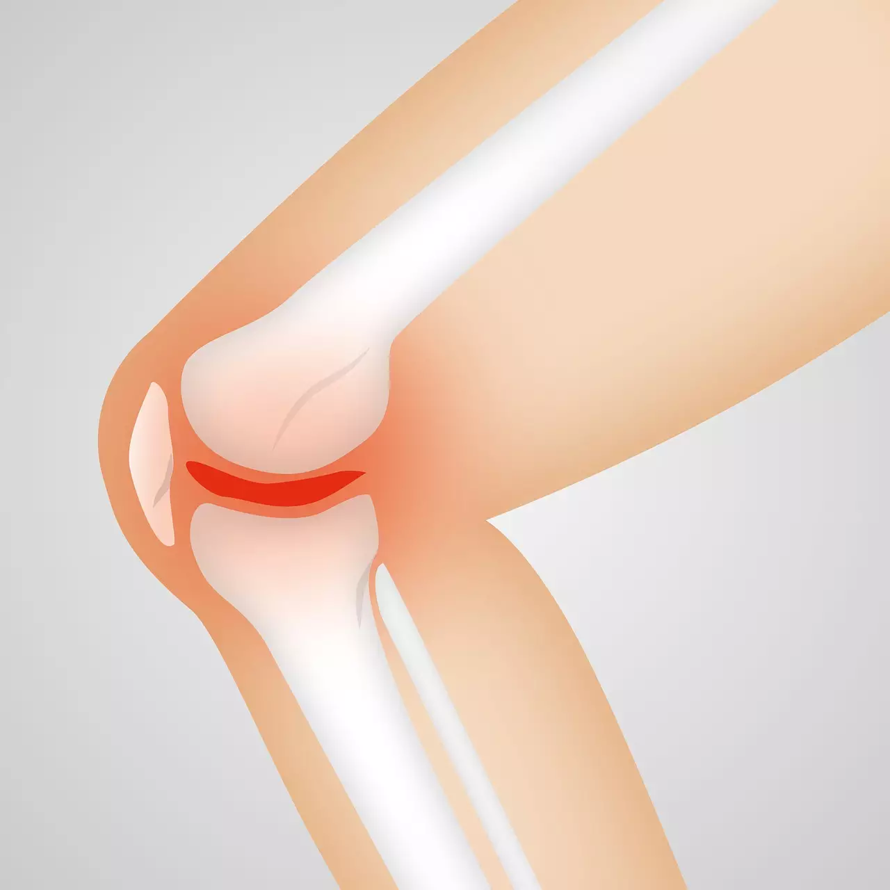 Knee osteoarthritis illustration